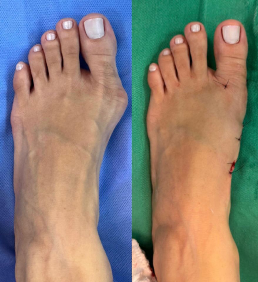 Antes e depois de cirurgia de joanete — caso 8, Dr. Gabriel Monteiro