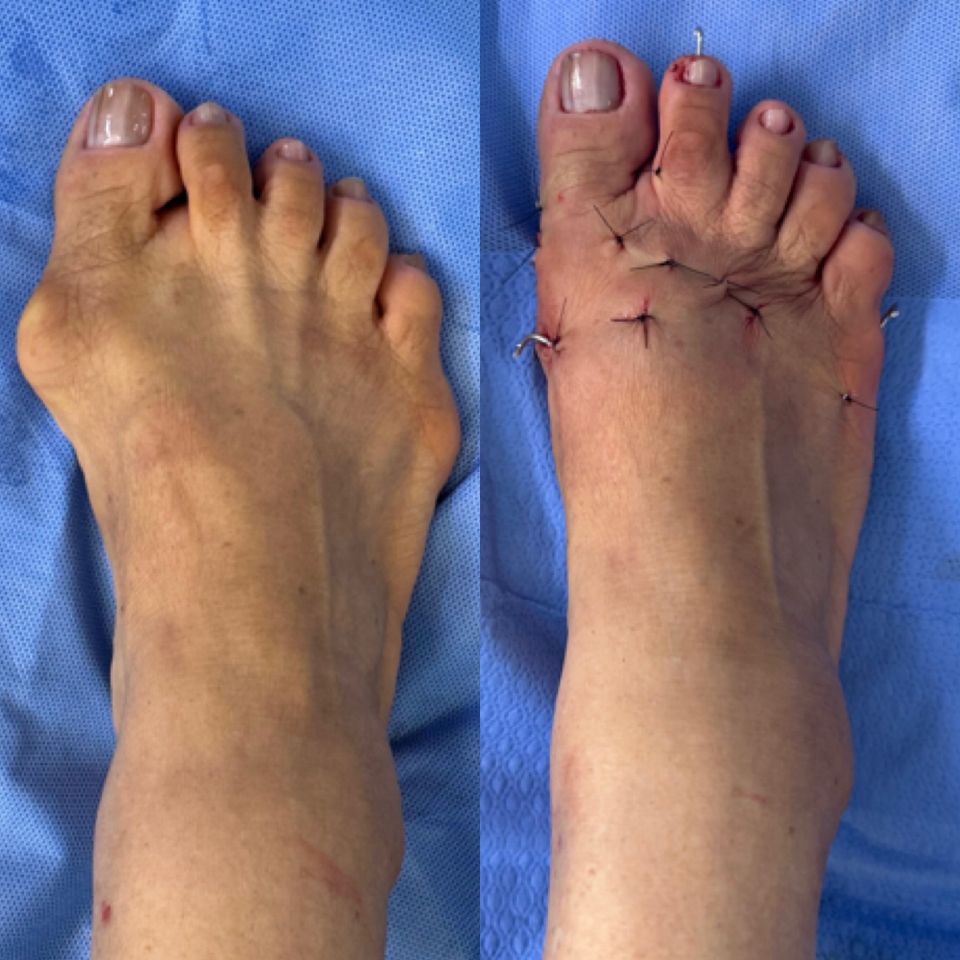 Antes e depois de cirurgia de joanete — caso 2, Dr. Gabriel Monteiro