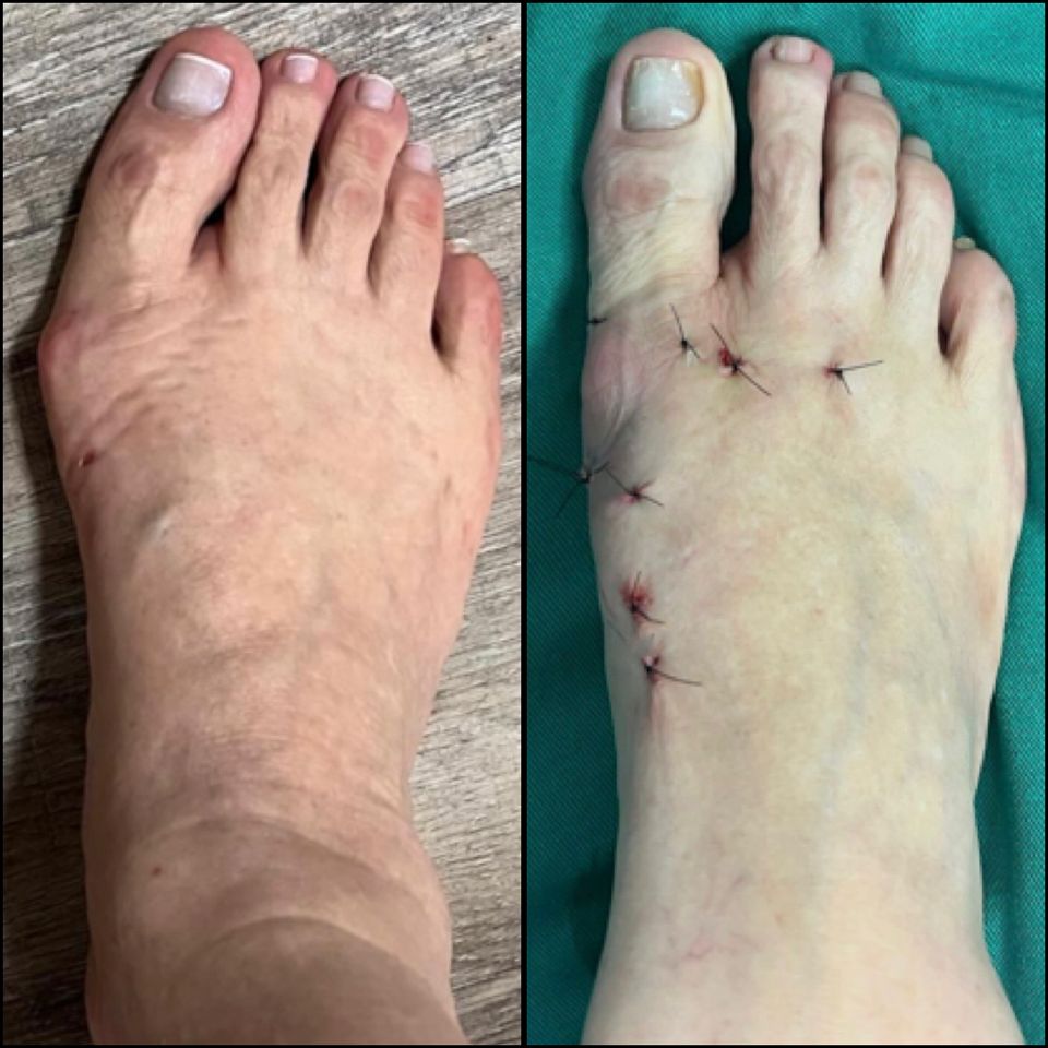 Antes e depois de cirurgia de joanete — caso 7, Dr. Gabriel Monteiro