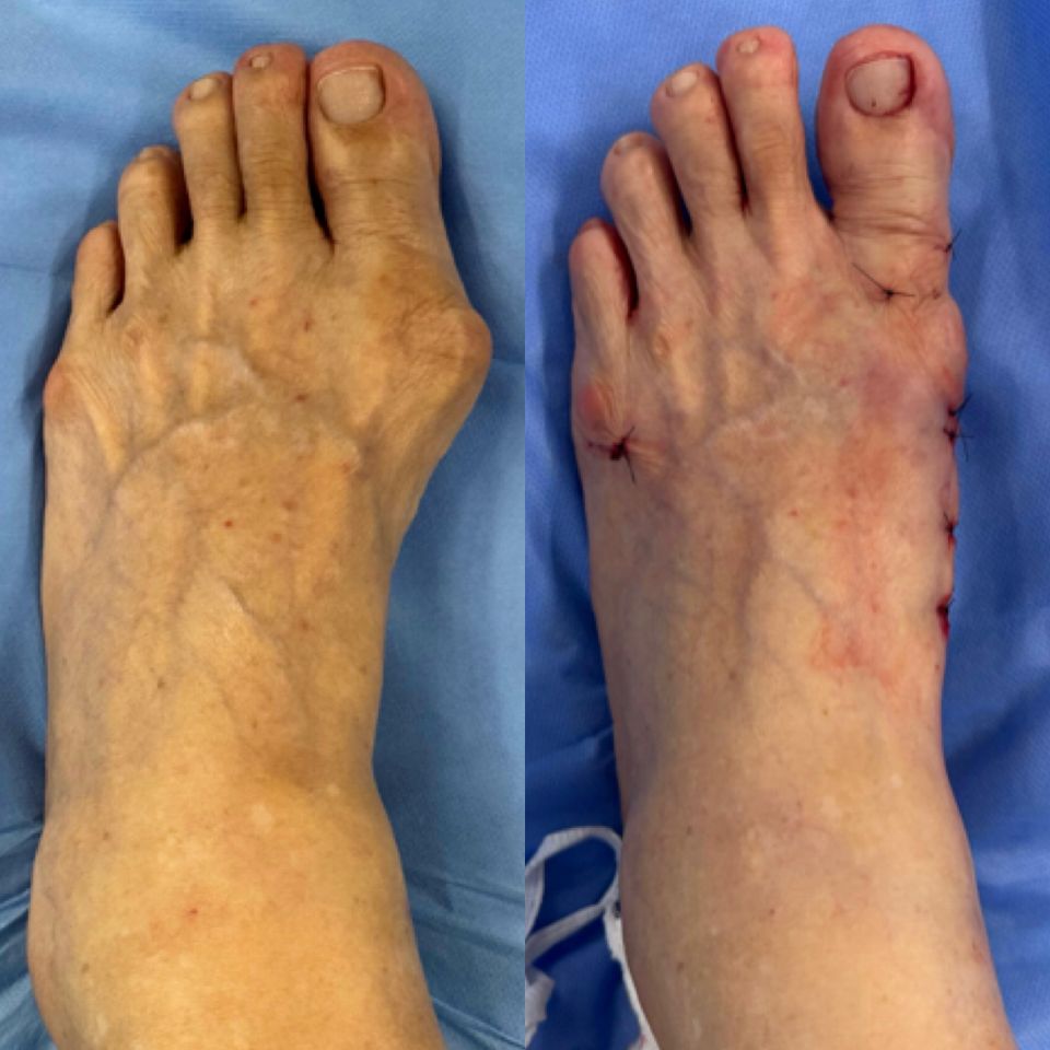 Antes e depois de cirurgia de joanete — caso 4, Dr. Gabriel Monteiro