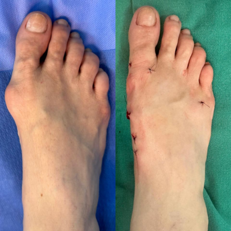 Antes e depois de cirurgia de joanete — caso 5, Dr. Gabriel Monteiro