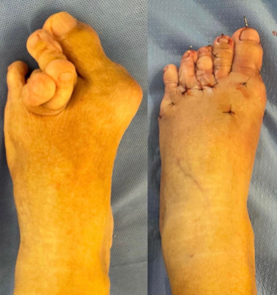 Antes e depois de cirurgia de joanete — caso 1, Dr. Gabriel Monteiro