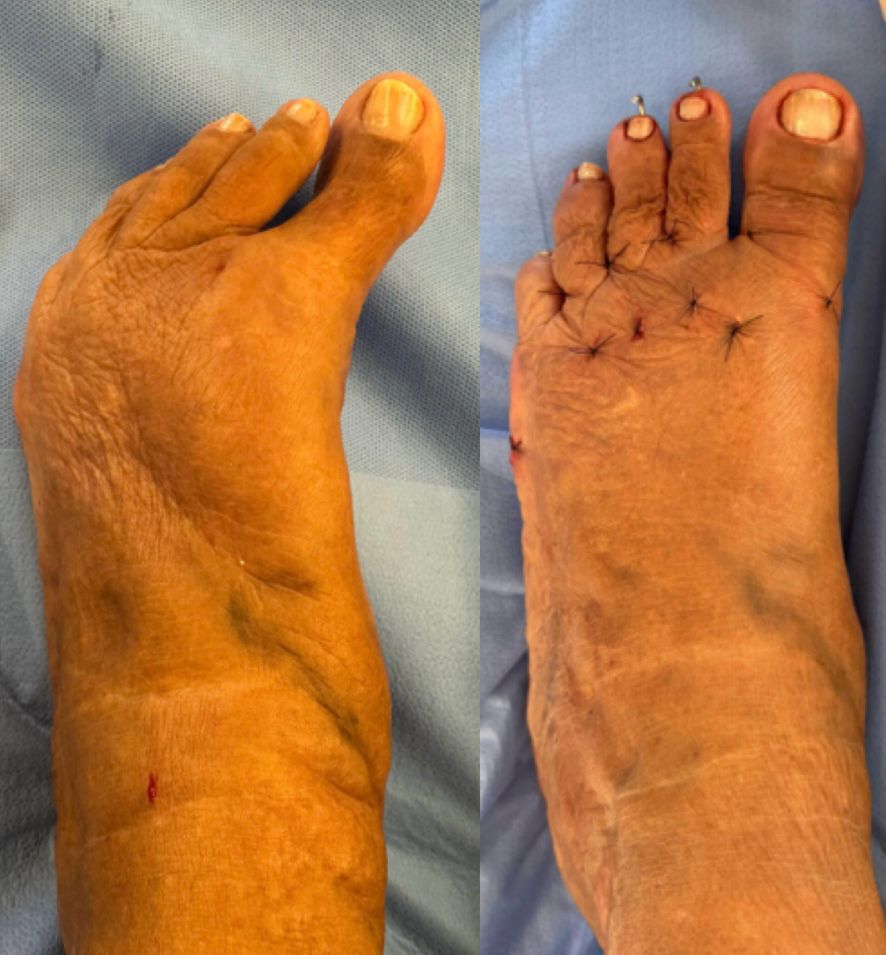 Antes e depois de cirurgia de joanete — caso 3, Dr. Gabriel Monteiro
