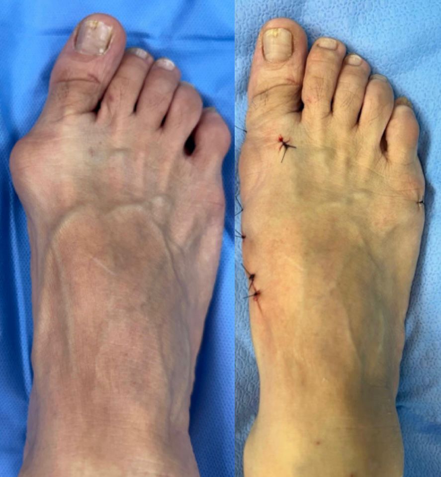 Antes e depois de cirurgia de joanete — caso 6, Dr. Gabriel Monteiro